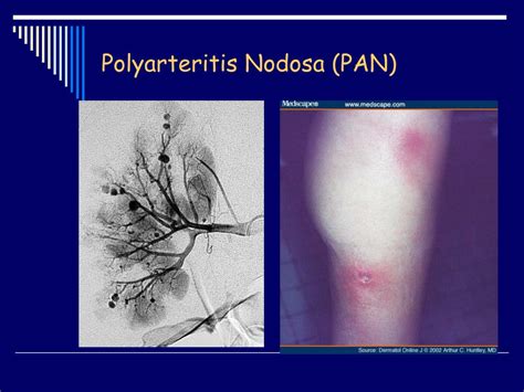 Pan Polyarteritis Nodosa