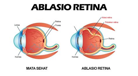 pandangan ablasio retina