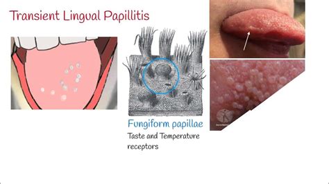 Papilite Lingual Transitória