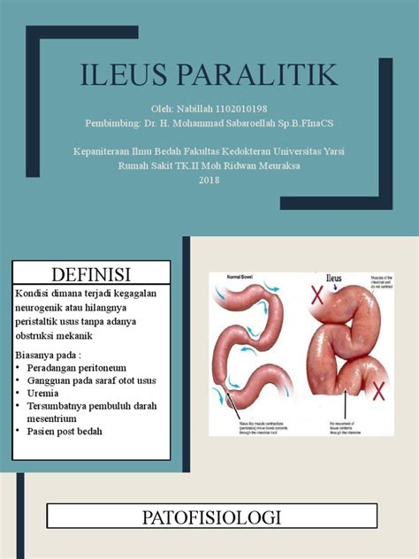 Paralitik Ileus Nedir