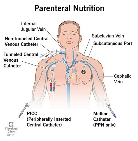 parenteral | Reference Neo Calc Application