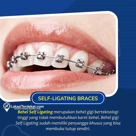 PASANG BEHEL TERDEKAT - Berapa harga pemasangan behel termurah namun aman?