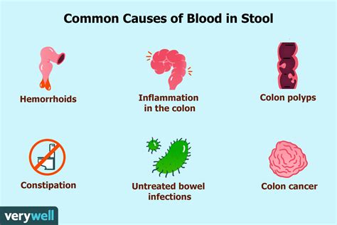 passing blood clots in stool