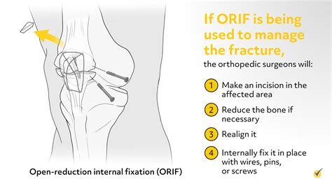 Patellar Fracture With Orif Protocol