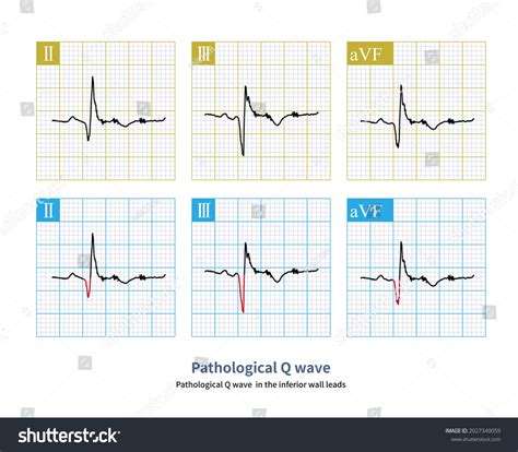 Pathologic Q Waves