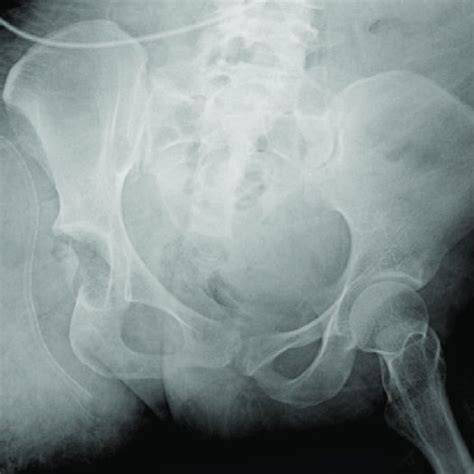 Pbh X Ray