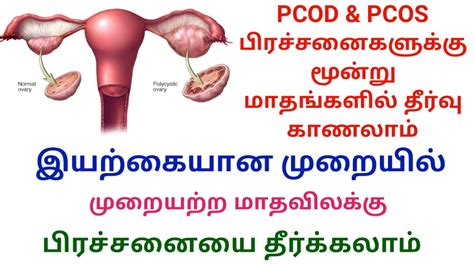 pcod problem treatment in tamil