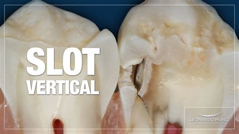 Pdf  Uses Of The Vertical Slot In Orthodontic Brackets - Mola Slot