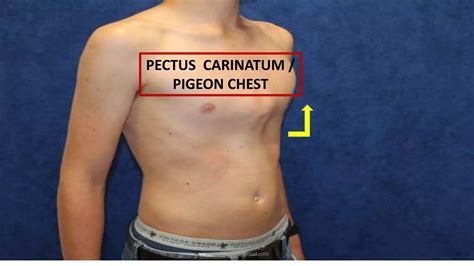 Pectus Pigeon Chest