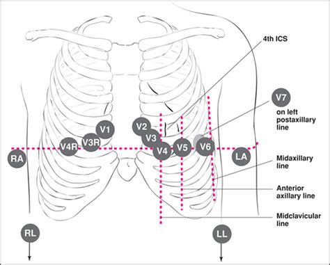 Pediatric Ecg Lead Placement