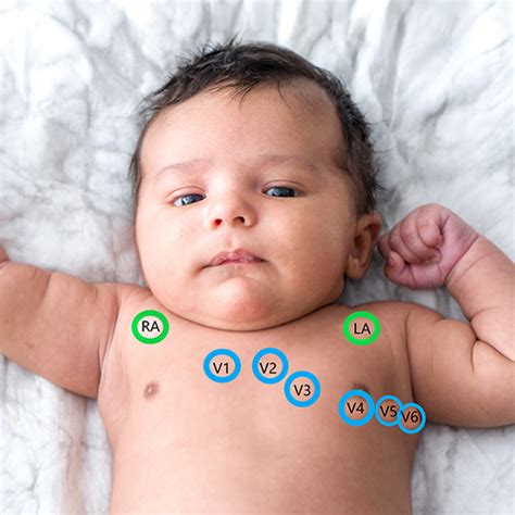 Pediatric Ecg Placement