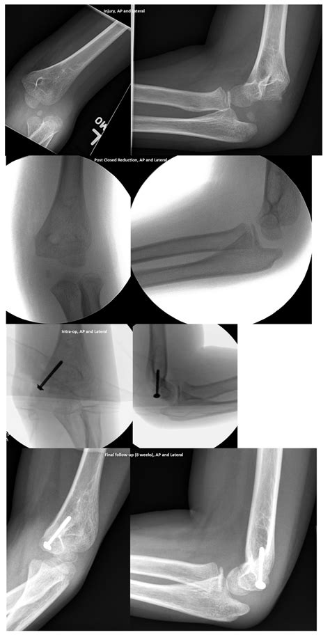 pediatric fractures and dislocations