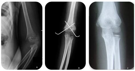 peds and pins