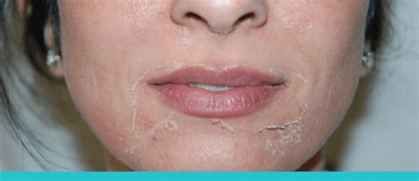 PEELING ARTINYA - Peeling Acne untuk Menghilangkan Jerawat, Ketahui Prosedur yang