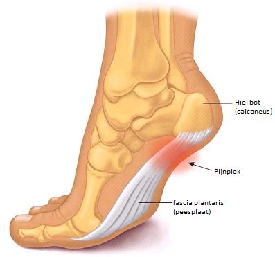 peesplaat ontsteking