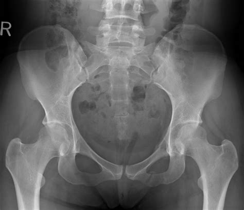 Pelvis X Ray
