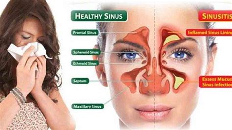 pengobatan sinusitis