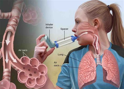 penyakit asthma
