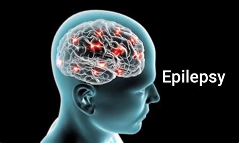 penyakit epilepsi