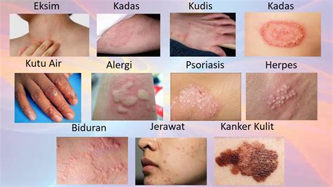 penyakit gatal pada kulit