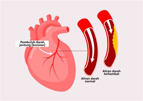 penyakit jantung koroner