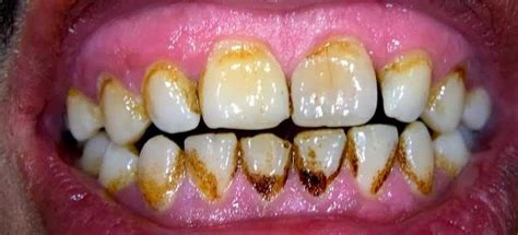 penyebab karang gigi