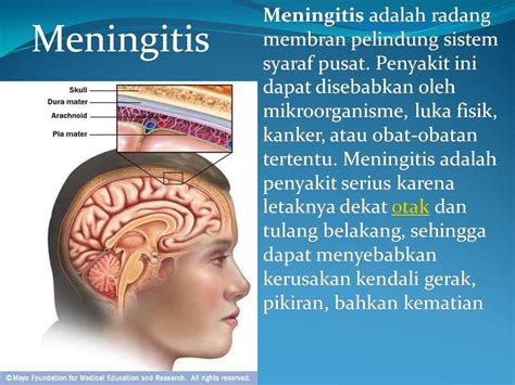 penyebab meningitis adalah