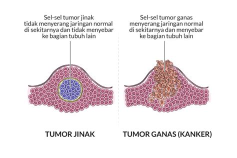 penyebab tumor
