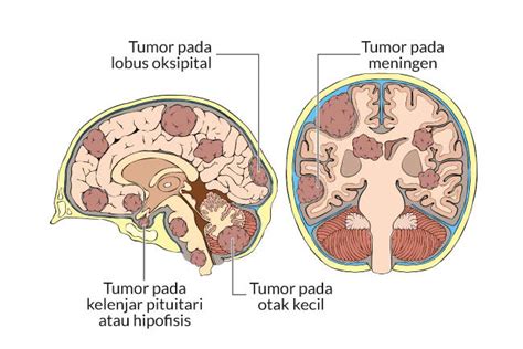  Penyebab Tumor Otak - Penyebab Tumor Otak
