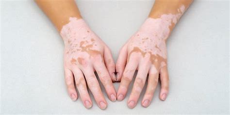 penyebab vitiligo