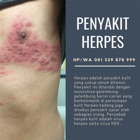 Penyebab Herpes Kulit dan Cara Mengatasinya: Atasi Gatal dan Lesi Menyakitkan