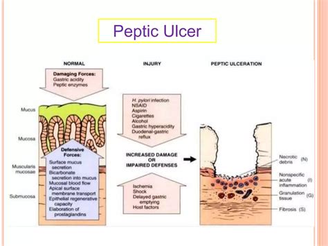 Peptic Ulcer Pathophysiology
