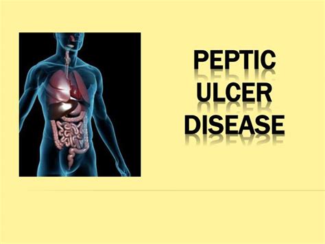 peptic ulcer ppt er