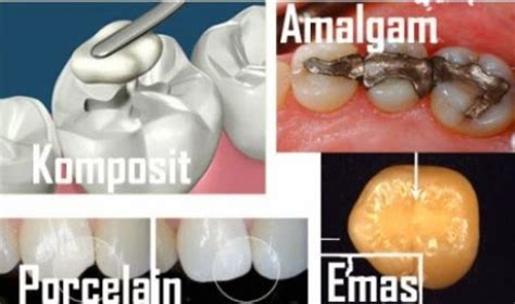 perbedaan tambal gigi di puskesmas dan dokter praktek