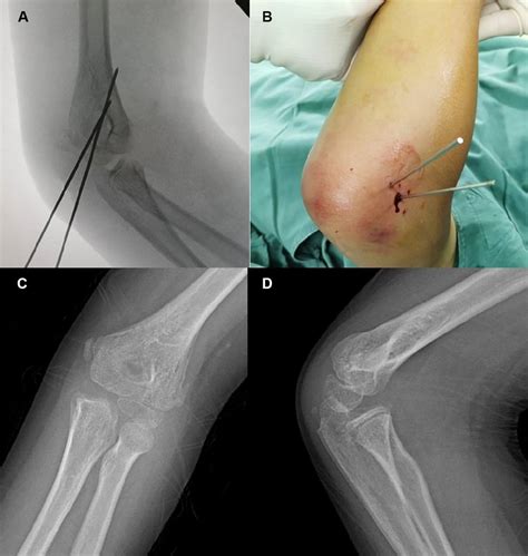 Perc Pinning Lateral Condyle