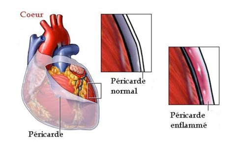 pericardite