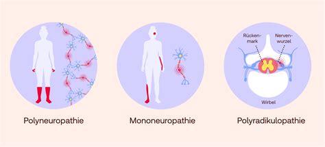 perifere polyneuropathie betekenis