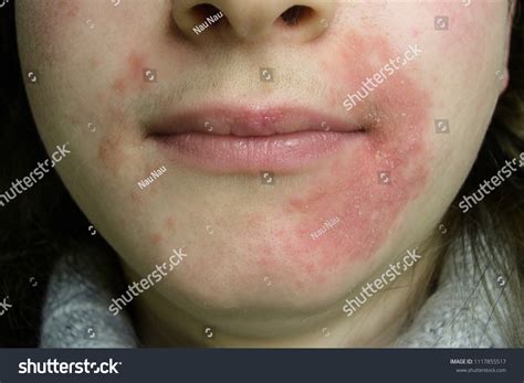 perioral dermatit bilder