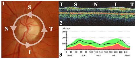 peripapillary rnfl classification