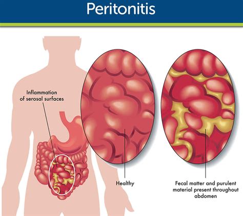 peritonitis adalah