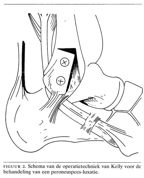 peroneuspees operatie ervaringen