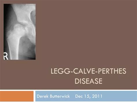 perthes disease ppt template