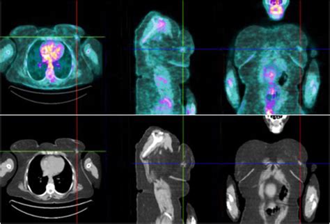 Pet Scan Fdg Uptake