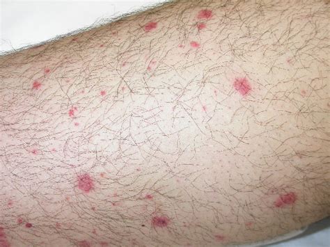 petechiae | Cutaneous eruptions from ibrutinib overlap with EGFRinduced