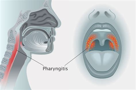 Read Pharyngitis In Louisiana 