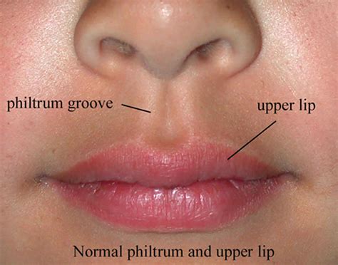 Philtrum