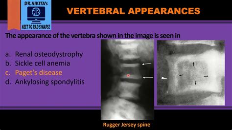 Picture Frame Vertebra