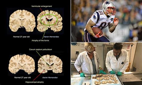 pictures of aaron hernandez brain damage