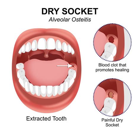 Pictures Of Dry Socket Vs Normal Healing