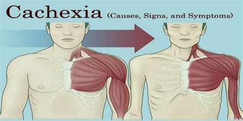 pierre cachexia biography